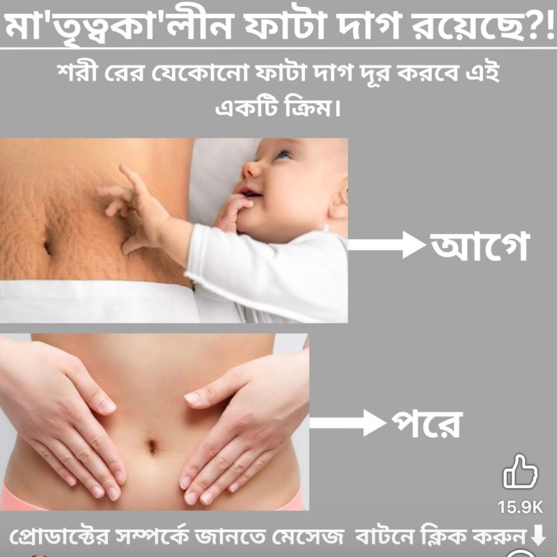 Anti-Stretch Mark Miracle Stick